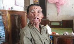 Xót thương người đàn ông mang thân hình  "quỷ dữ "