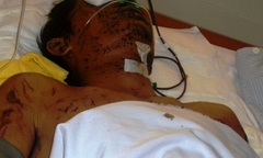 Nạn nhân sống sót trong vụ nổ bom đã qua cơn nguy kịch