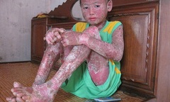 Cảm thương cháu bé mắc bệnh vảy nến thể mủ