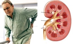 Điều trị sỏi thận, sỏi mật  bằng thuốc Đông Y   