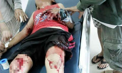 Lựu đạn nhựa phát nổ, 2 cháu bé nhập viện cấp cứu