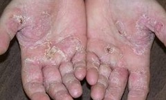 Hỏi và đáp về bệnh vẩy da