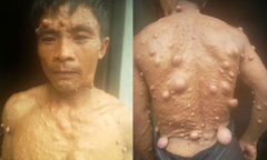 Cám cảnh cả gia đình bị bệnh tật hành hạ