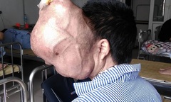 Khối u “ăn” não, người đàn ông đau đớn đợi phẫu thuật