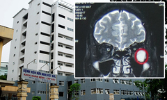 Kỹ thuật mổ nội soi u hốc mắt qua đường mũi: Thành công trong lần đầu tiên