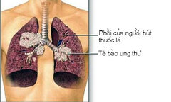 Thuốc lá nguyên nhân chính gây ra ung thư phổi