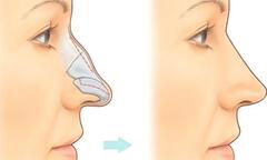 Mũi bị gồ cứ để V.I.P lo