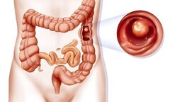 Sáng chế “đột phá” của người Nhật trong hỗ trợ điều trị viêm đại tràng