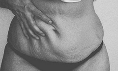 Da xỉn màu sau sinh vì cố giảm cân nhanh