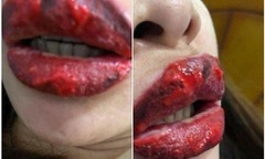 Đau đớn với hai  "quả chuối hột " mưng mủ vì xăm môi trái tim