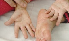 Hà Nội: Trẻ mắc tay chân miệng đang gia tăng với tốc độ chóng mặt