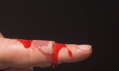 Những bệnh nhân được bảo hiểm chi trả hàng tỷ đồng