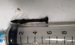 Bị cây đinh gỉ văng vào phổi, người đàn ông liên tục ho ra máu