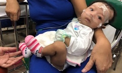 Cứu bé gái 2 tháng tuổi mắc bệnh hiếm gặp hình thành từ lúc bào thai