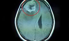 Đau đầu, yếu nửa người cẩn thận u não nguy hiểm chết người