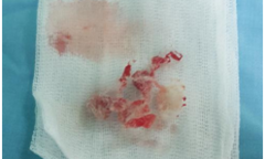 Bác sĩ cảnh báo về dị vật ở  "chỗ khó nói " 