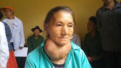 Người phụ nữ có khối u khổng lồ trên cổ