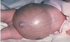 Cháu bé có khối u 10cm, bác sĩ tiên lượng tốt, gia đình khăng khăng cho dùng thuốc Nam