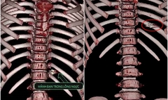 Mảnh đạn găm vào ngực bé gái 7 tuổi được lấy ra thế nào?
