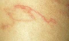 Giun lươn bò ngoằn ngoèo dưới da bệnh nhân Việt Kiều 50 tuổi