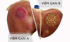 Tất tần tật về viêm gan B – Phòng tránh & cách điều trị