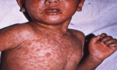 Bệnh có thể mắc ở bất cứ lứa tuổi nào: Phát hiện sớm và chăm sóc ra sao?