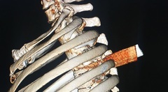 Lấy lưỡi dao gần 6 cm đâm thấu ngực bệnh nhân