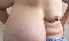 Khối u khổng lồ gây họa nhưng người bệnh vẫn  "ngó lơ "