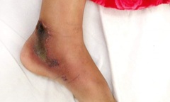 Rắn hổ mèo nguy hiểm tấn công cháu bé lớp 5