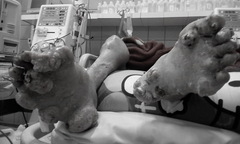 Chân tay biến dạng vì căn bệnh phổ biến ở đàn ông