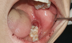 Nhổ răng khôn, máu chảy ồ ạt vì nguyên nhân không ngờ