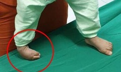 Bác sĩ  "uốn " chân cong thành thẳng cho bé 16 tháng tuổi