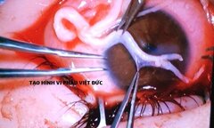 Những  "bàn tay vàng " nối sợi thần kinh chỉ 1mm giúp đôi mắt thoát khỏi mù lòa