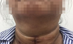 Bị bệnh mà không điều trị, bệnh nhân gặp nguy hiểm khi khối u chèn ép khí quản