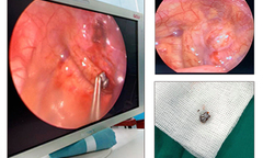 Đạn súng săn xuyên từ cổ xuống phổi 