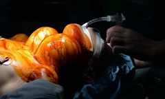 Mổ thành công u bướu khổng lồ nặng 4kg