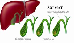 Những dấu hiệu sớm cảnh báo nguy cơ sỏi mật