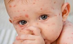 Bệnh sởi bùng phát tại 43 tỉnh thành trên cả nước