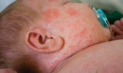 Dịch sởi bùng phát tại 56 tỉnh thành: Người dân nên chủ động phòng tránh