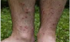 Dấu hiệu nhận biết, cách dự phòng hiệu quả sán dây lợn và các bệnh giun sán khác