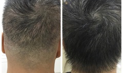 Phương pháp “thần kỳ” giúp tóc mọc dày gấp đôi tại bệnh viện Quốc tế DNA