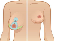 Treo ngực sa trễ là gì, có giống với nâng ngực không?