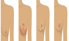 Các cấp độ và phương pháp treo ngực sa trễ