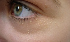 Bệnh mụn cơm phẳng, nguyên nhân, hậu quả và cách điều trị tốt nhất 