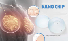 Những ưu điểm nổi trội của phương pháp thẩm mỹ nâng ngực nano chip