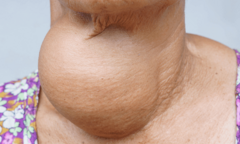 Ứng dụng kỹ thuật mới trong điều trị triệt để u tuyến giáp 