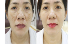 Thẩm mỹ viện quốc tế Bắc Âu điều trị sạch nám sáng da 1 lần