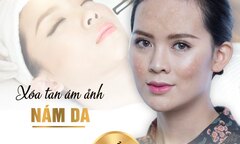 Thẩm mỹ viện quốc tế Bắc Mỹ trị nám uy tín tại Thanh Hóa