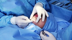 4 điều  "cấm kỵ " cần biết trước khi độn cằm