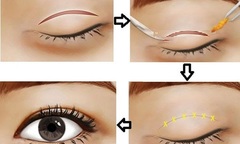 Giải pháp xóa bỏ mọi dấu vết thời gian cho  "cửa sổ tâm hồn "